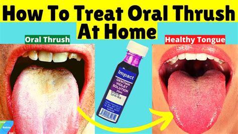 How To Treat Oral Thrush At Home How To Treat Candida At Home Youtube