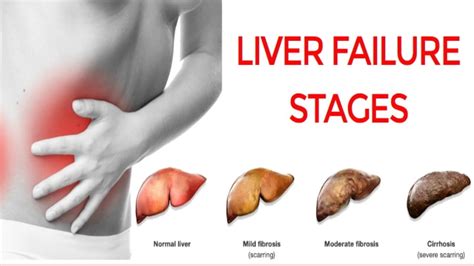 Liver Failure Stages Youtube