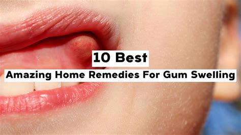 10 Best Amazing Home Remedies For Gum Swelling Youtube