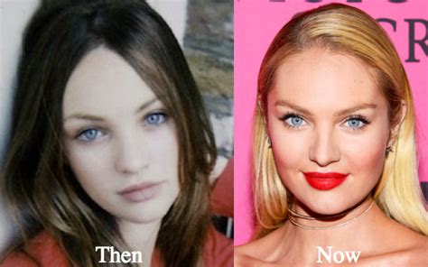 Candice Swanepoel Plastic Surgery Before And After Photos Latest