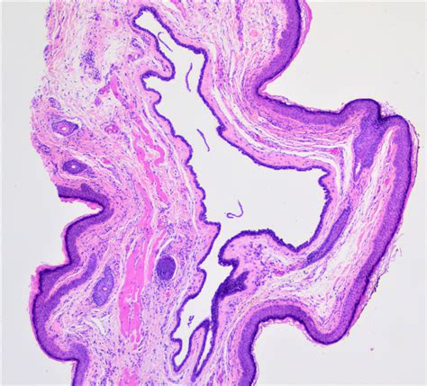 Pathology Outlines Eyelid Cysts