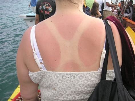 Gallery 13 Of The Worst Sunburn Pictures We Could Find · The Daily Edge