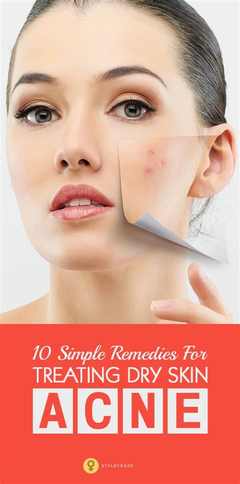 12 Home Remedies To Remove Acne From Dry Skin Dry Skin Acne How To