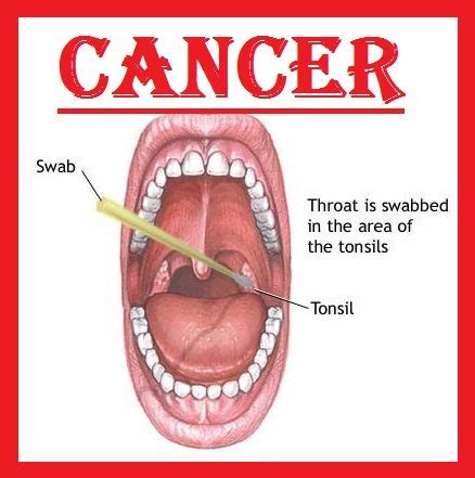 Early stage neck cancer images. Throat cancer