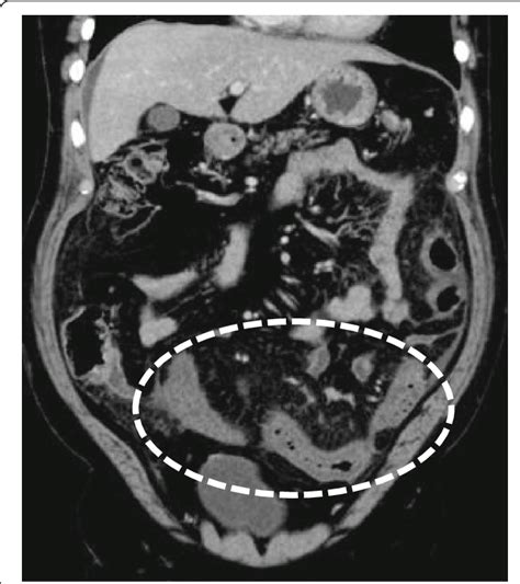 Portal Venous Phase Ct Of The Abdomen Demonstrating Marked Wall