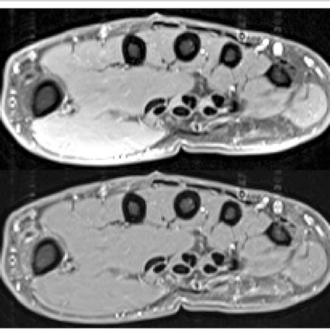 Top Axial Slice Of A T1 Weighted Fat Suppressed Mri Hand Scan In The