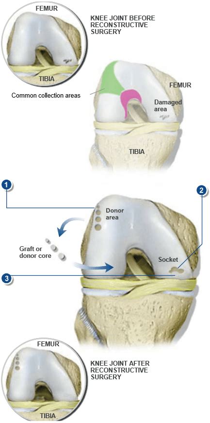 Knee Cartilage Replacement Surgery Dr Patrick Chin Orthopedic Surgeon Vancouver