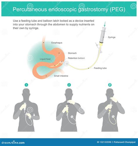 Percutaneous Endoscopic Gastrostomy Peg Stock Vector Illustration Of