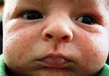 Images of How To Treat Heat Rash On Babies Naturally