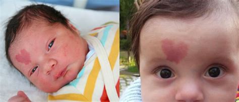 “gorgeous Natural Phenomenon” Child Was Born With A Heart Shaped Birthmark