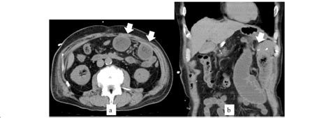 A B Ct Scan Imaging Of Jejunojejunostomy Obstruction Imaging Of Case