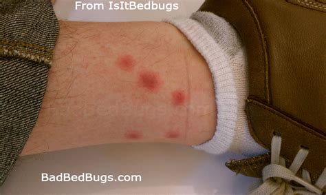 Bed Bug Bites And Quick Help Including These Infestations Tips