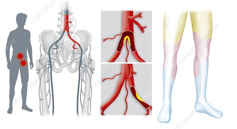Lower Extremity Arterial Stenosis
