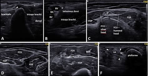 Role Of Dynamic Sonography In Ulnar Nerve Entrapment At Elbow The My