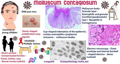 Pathology Of Molluscum Contagiosum Dr Sampurna Roy Md