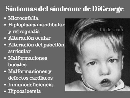 Digeorge syndrome is a condition present from birth that can cause a range of lifelong problems, including heart digeorge syndrome is caused by a problem with a person's genes, called 22q11 deletion. SINDROME VELOCARDIOFACIAL PDF