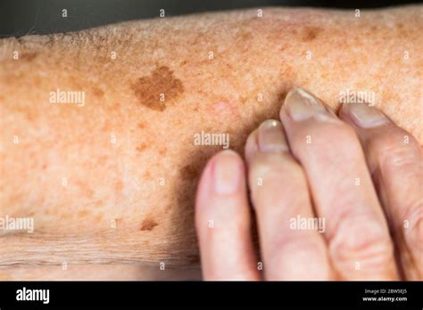 Liver Spots Or Age Spots On An Elderly Womans Skin Stock Photo Alamy