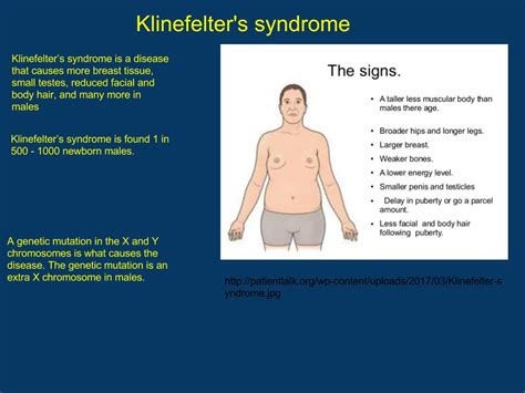 Gutierrez Genetics Research Project Klinefelters Syndrome Andres