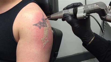 Tattoo Removal Process What To Expect Tattoo Removal Institute