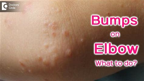 Bumps On Elbows Causes Of Itchy Non Itchy Bumps Treat