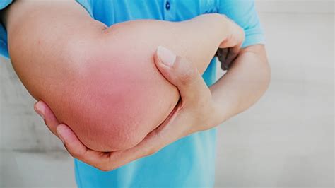 Elbow Sprain Symptoms The Causes And Effective Treatment