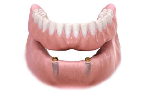 Implants Retained Dentures In Drighlington Whitehall Dental Care