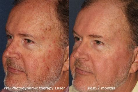 Skin Cancer Treatment Experts San Diego Ca Clderm