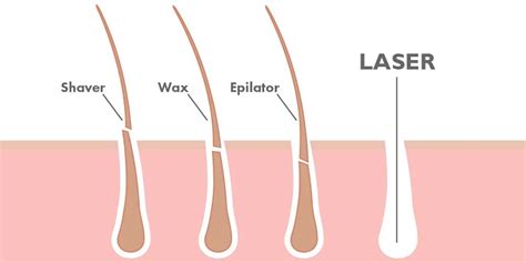 How Much Is Brazilian Laser Hair Removal The Daily Glimmer