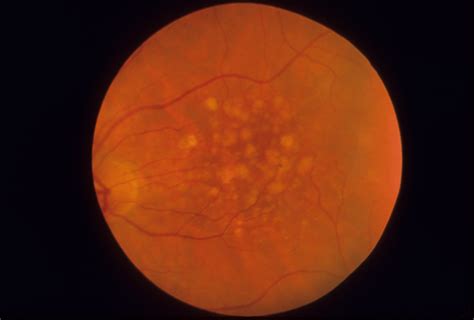 Doyne Honeycomb Macular Dystrophy Hereditary Ocular Diseases