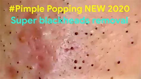 Pimple Popping 2020 Video 02 Blackheads Whiteheads And Inflamed