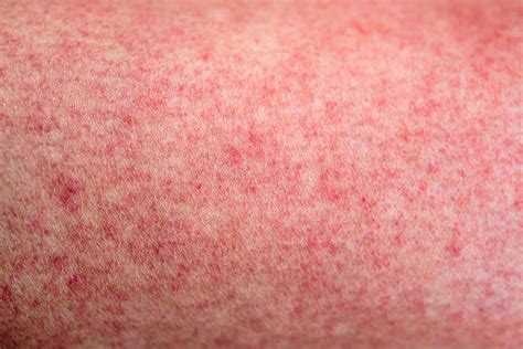 Another type of dengue rash is characterized by clustered dots which may appear anywhere across the body once the fever begins to subside. Skin With Dengue Fever Red Rashes Stock Photo - Download ...