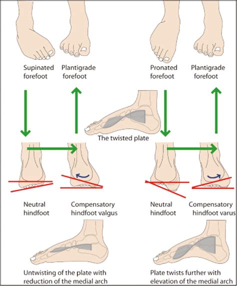View Of Biomechanical Basis For Treatment Of Pediatric Foot Deformities