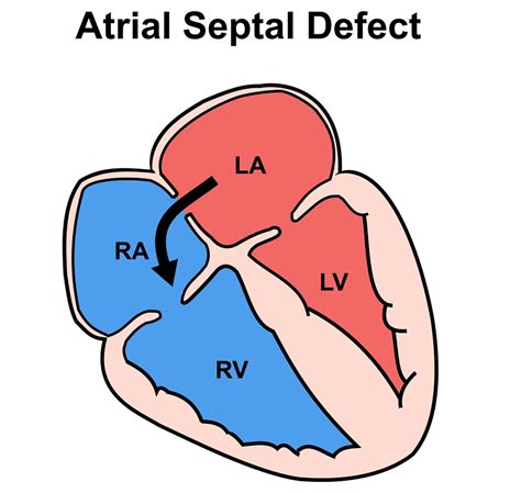 Atrial Septal Defect Causes Symptoms Types Diagnosis