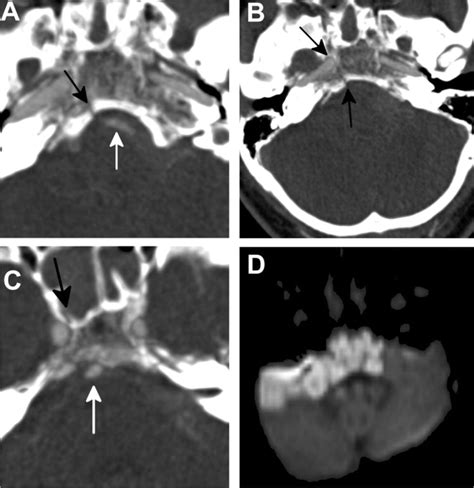 Teaching NeuroImages:Locked-in syndrome resulting from ...