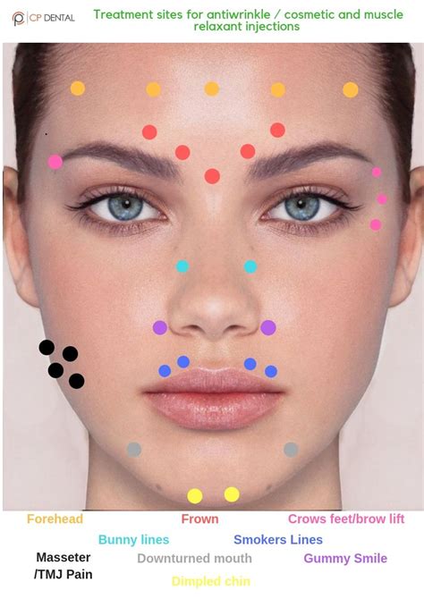 Diagram Botox Lip Flip Injection Points