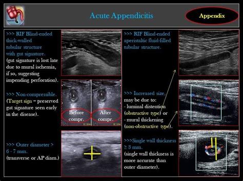Appendicitis Ultrasound Radiopaedia Appendicitis Is Inflammation Of The
