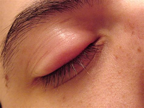 Swollen Eyelid Causes Symptoms Pictures Treatment Healthmd