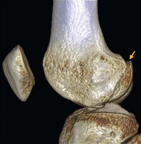 Fracture Of The Lateral Femoral Condyle Journal Of Orthopaedic