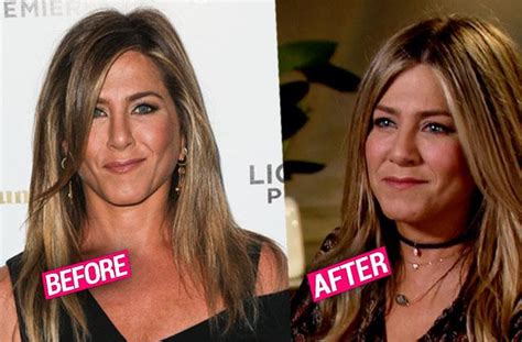 More Plastic Surgery Jennifer Aniston Gets Fillers For Plumper Cheeks