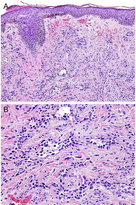 Cutaneous Angiosarcoma A Current Update Journal Of Clinical Pathology