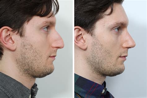 Nose Job Before And After Men
