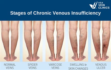 Chronic Venous Insufficiency Causes Symptoms Diagnosis And More Hot
