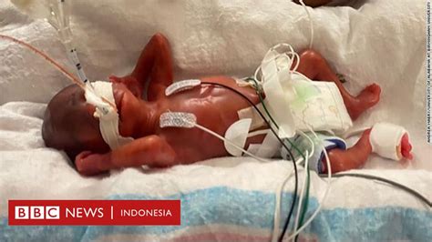 Kisah Bayi Paling Prematur Di Dunia Lahir Saat Usia Kehamilan Ibunya
