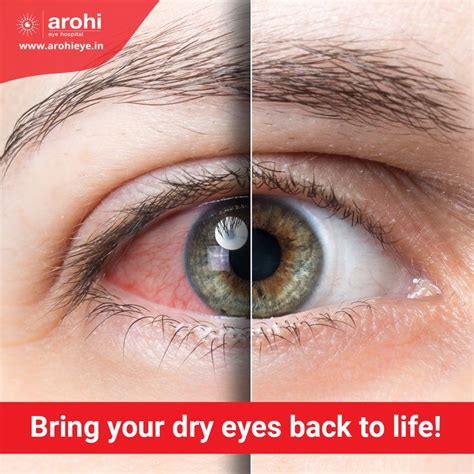 Dry Eyes Excessive Redness And Eye Irritation Consult An Expert