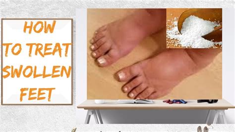 Swollen Feet Effective Remedies To Treat Swollen Feet At Home Youtube