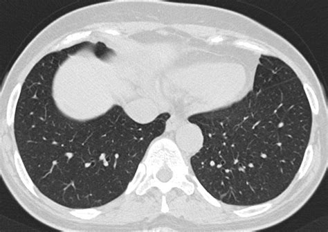 Ct Findings In Pulmonary Asbestosis Two Cases In Different Stages