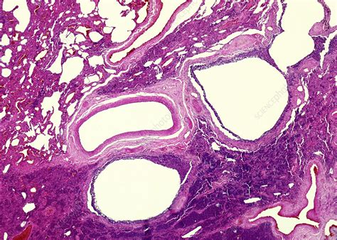 Pulmonary Fibrosis Light Micrograph Stock Image C0500337
