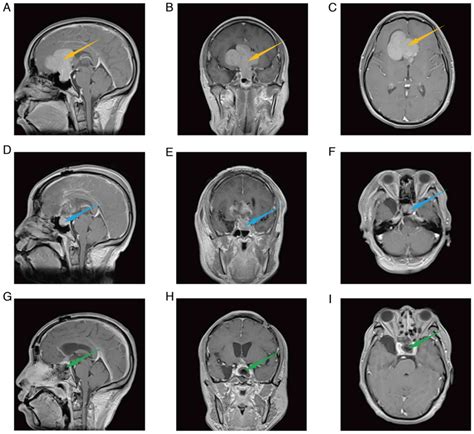 Staged Surgery For Irregular Giant Pituitary Adenomas A Report Of Two