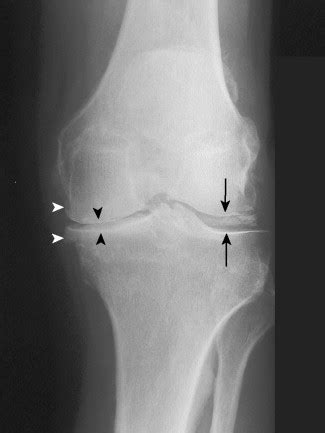 Imaging Hyperparathyroidism And Renal Osteodystrophy Radiology Key