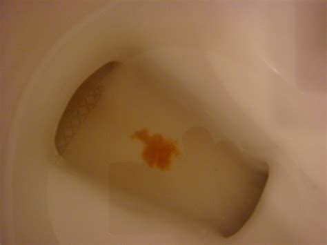 Bloody Mucus When Urine In Men New Health Advisor